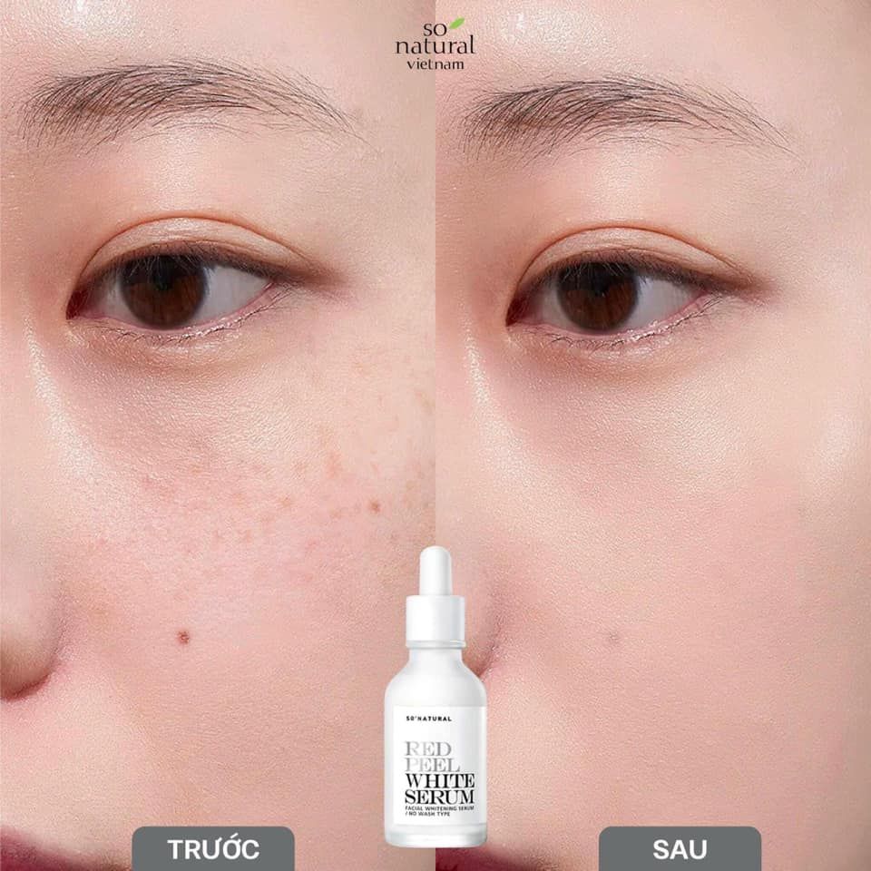Tinh Chất Dưỡng Trắng Làm Đều Màu Da So Natural Red Peel White Serum 35ml