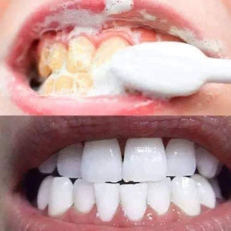 Median - KĐR Dental IQ 93% #White