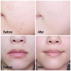 SVR - Sebiaclear Active Cream 40ml