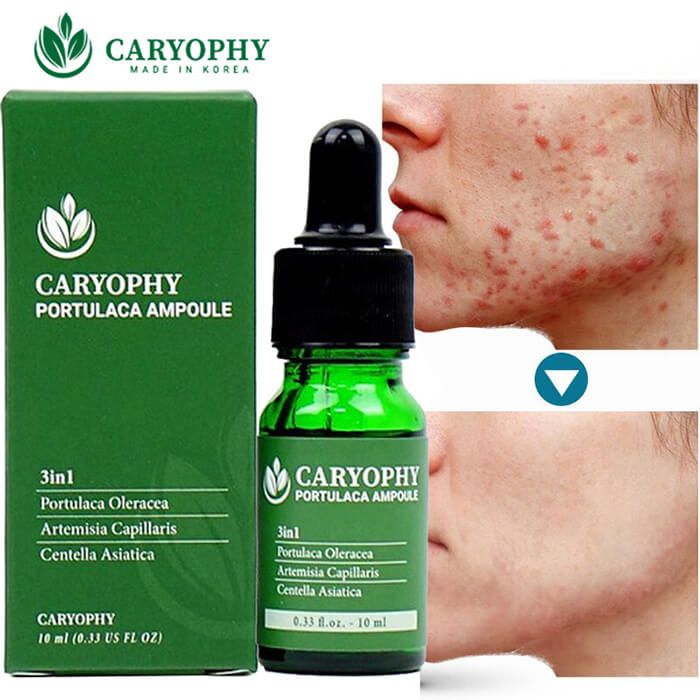 Caryophy - Serum Trị Mụn - Mờ Thâm 10ml