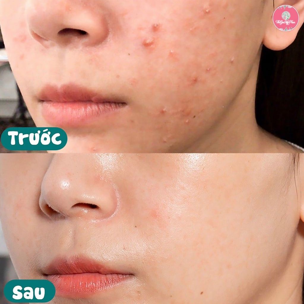 Some By Mi - Kem Dưỡng Đặc Trị Mụn 14 Days Super Miracle Spot All Kill