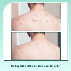 Some By Mi - Sữa tắm Miracle Acne 400ml