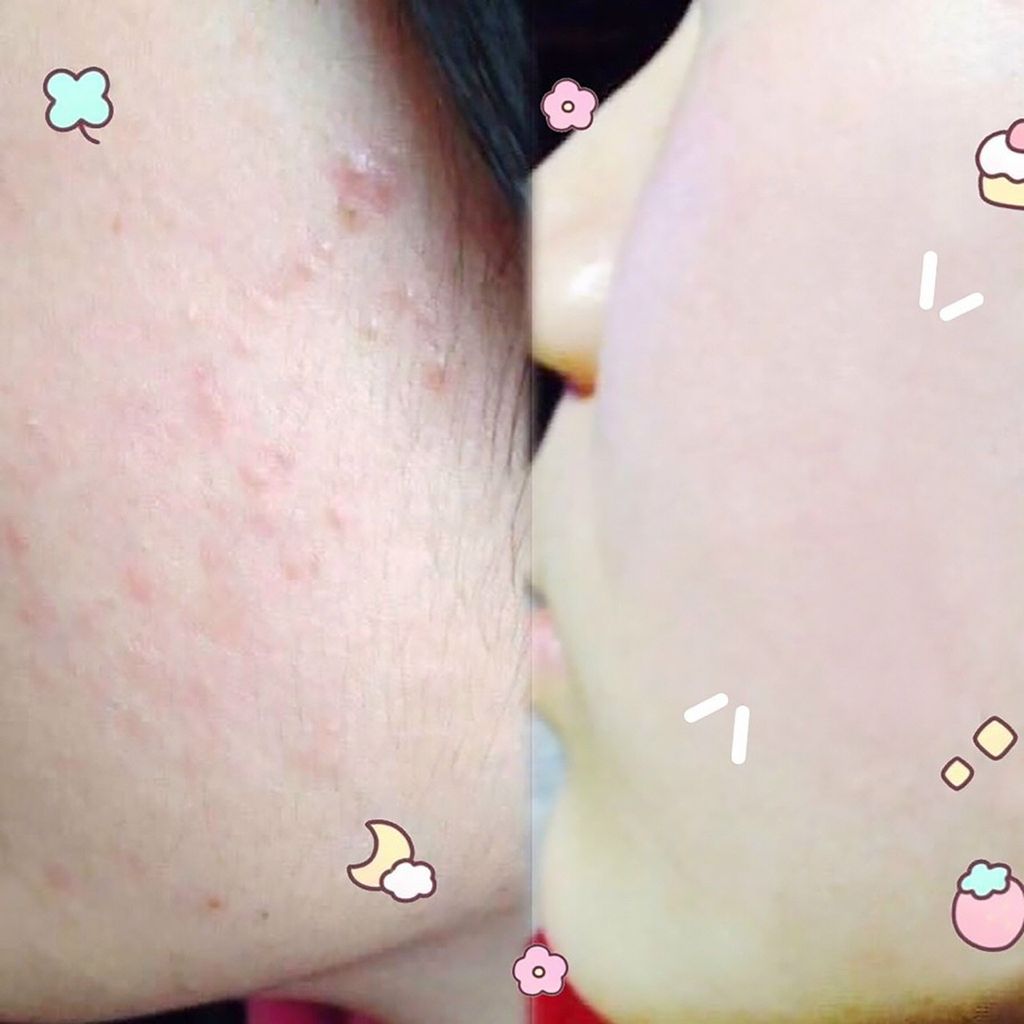 Kem Dưỡng Da Mụn Kracie Hadabisei Facial Cream 50g SALE 320K>258K