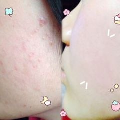Kem Dưỡng Da Mụn Kracie Hadabisei Facial Cream 50g SALE 320K>258K
