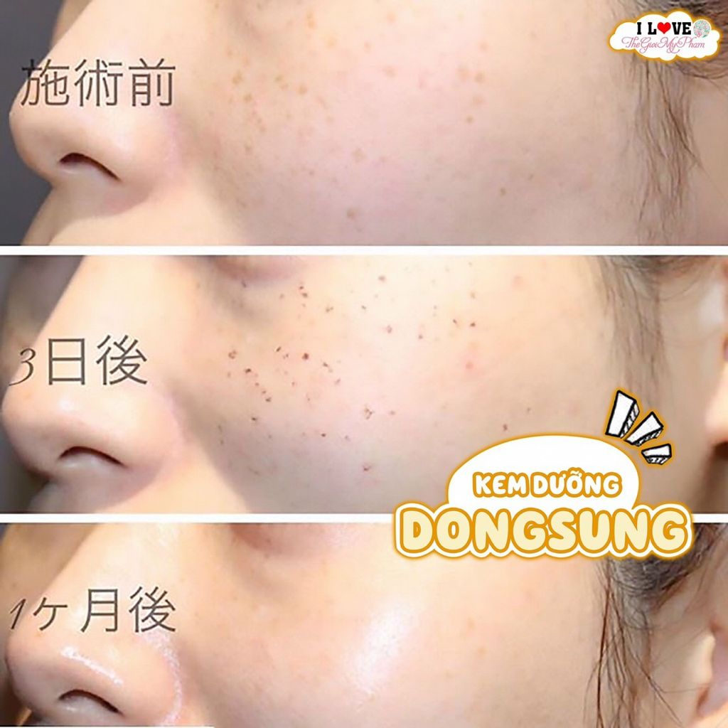 Kem Trị Nám Dongsung Rannce Cream 70g