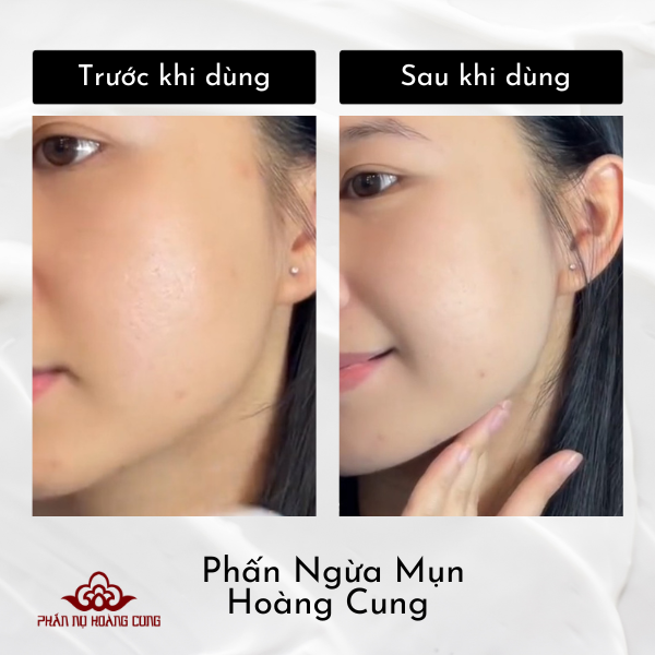 Combo Dưỡng Da Phấn Chống Lão Hóa + Phấn Ngừa Mụn - PHẤN NỤ HOÀNG CUNG