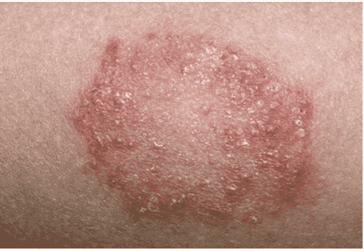 Chức nănaBệnh viêm da do nấm ringworm trên ngườig sinh lý da của chó