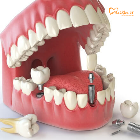  Cấy ghép Implant 
