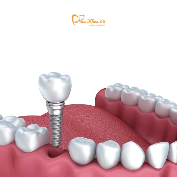  Cấy ghép Implant 