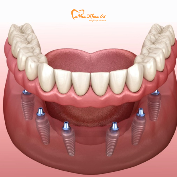  Cấy ghép Implant 