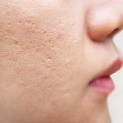 Điều trị sẹo