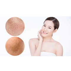 Điều trị nám da