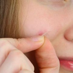 Miếng Dán Mụn HEALING PATCHES KA GCG (54 Miếng Dán)