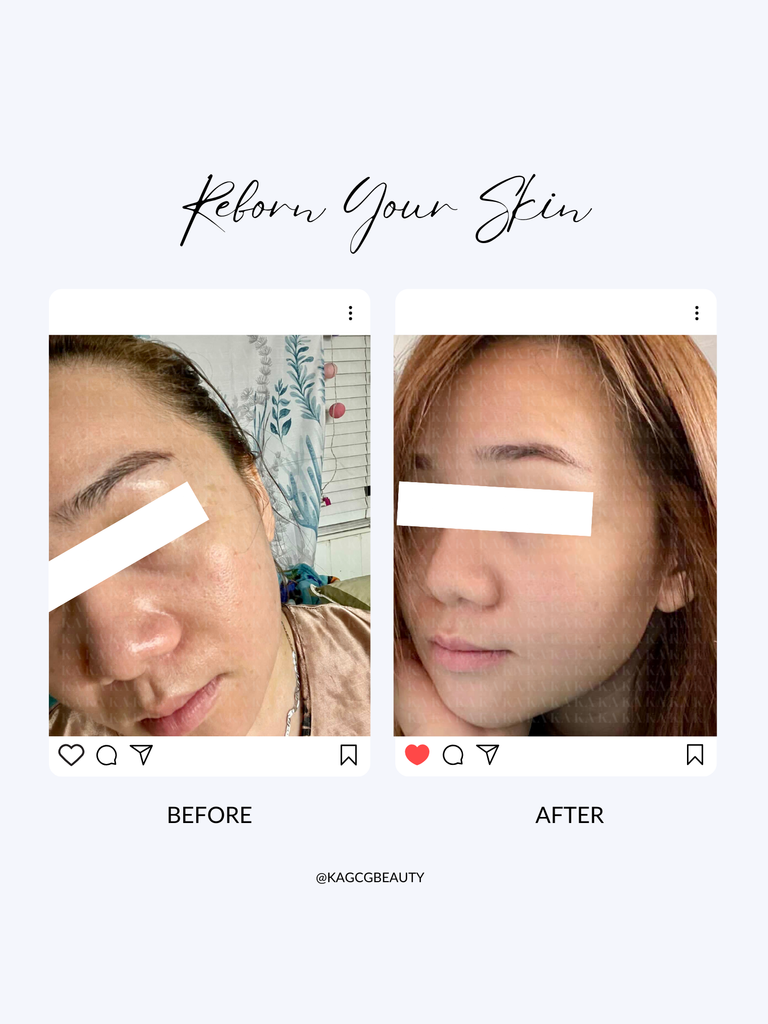 Kem Dưỡng Trị Nám Da 5V CREAM KA GCG