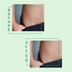 Kem Trị Rạn Da STRETCHEAL Anti Stretch Marks & Scars