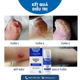  Gel chống loét tiểu đường LAVIOR Diabetic Wound Gel 15ml/ 50ml 