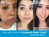  Gel Trị Sẹo Lồi Scarguard Repair Liquid 15ml (Scarguard MD) 