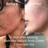  Kem trị mụn mật ong Manuka Biohoney Natural Acne Cream 50g 