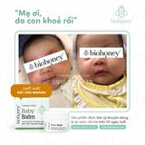  Kem Biohoney Baby Balm - Hết chàm sữa, viêm da, hăm tã, mẩn ngứa,... 