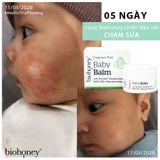  Kem Biohoney Baby Balm - Hết chàm sữa, viêm da, hăm tã, mẩn ngứa,... 