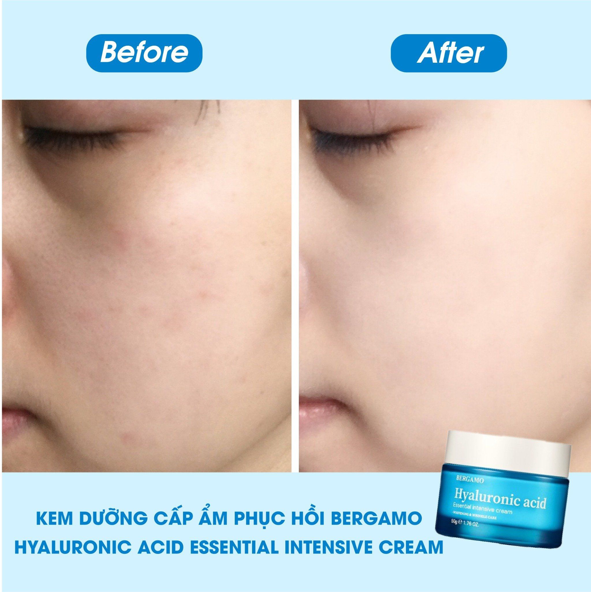 KEM DƯỠNG CẤP ẨM HỖ TRỢ PHỤC HỒI BERGAMO HYALURONIC ACID ESSENTIAL INTENSIVE CREAM 50G