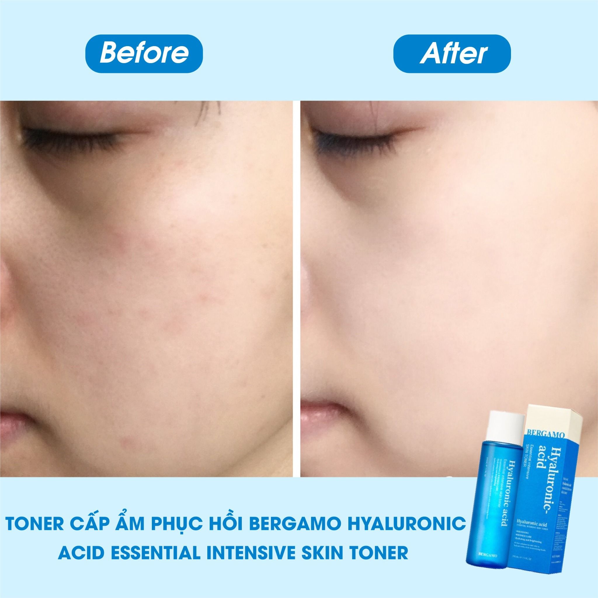 TONER CẤP ẨM HỖ TRỢ PHỤC HỒI BERGAMO HYALURONIC ACID ESSENTIAL INTENSIVE SKIN TONER 210ML