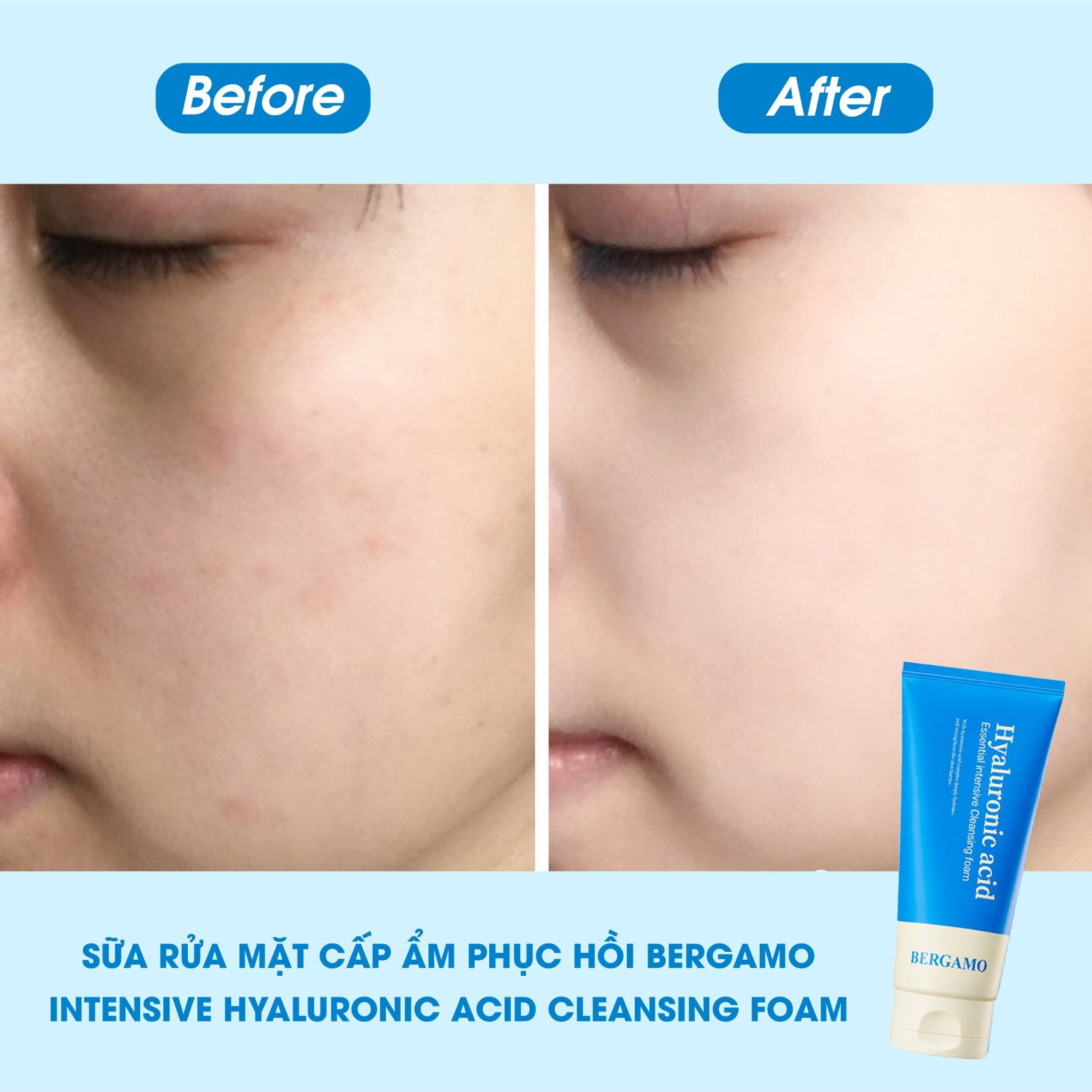 SỮA RỬA MẶT CẤP ẨM HỖ TRỢ PHỤC HỒI BERGAMO INTENSIVE HYALURONIC ACID CLEANSING FOAM 120ML