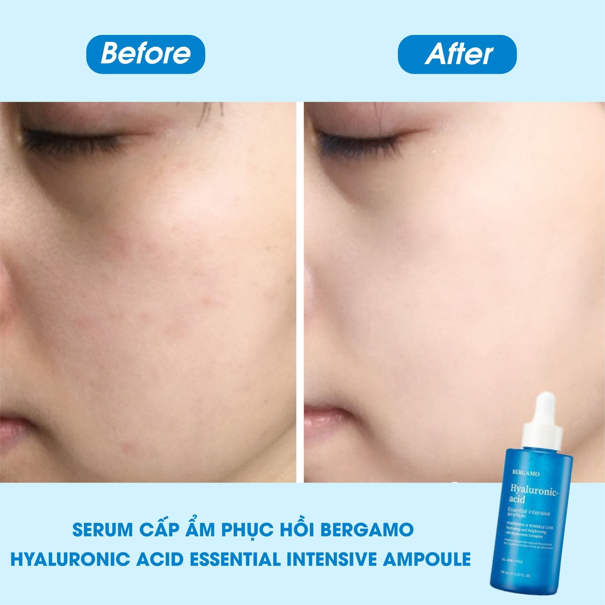 SERUM CẤP ẨM HỖ TRỢ PHỤC HỒI BERGAMO HYALURONIC ACID ESSENTIAL INTENSIVE AMPOULE 150ML