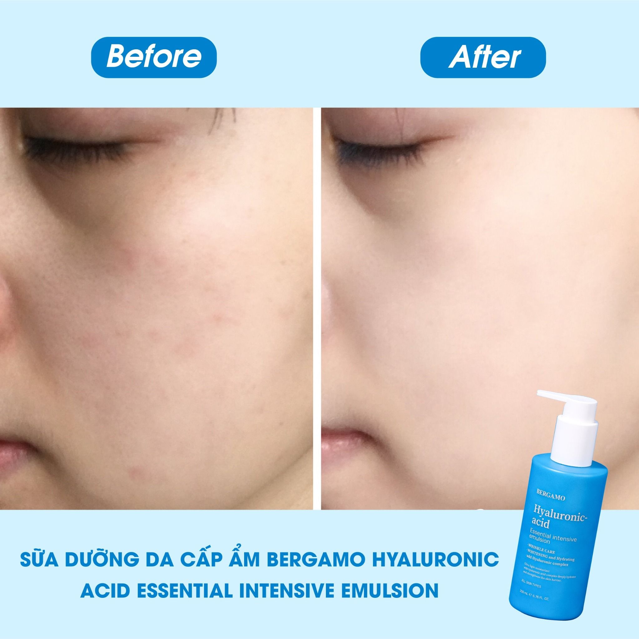 SỮA DƯỠNG DA CẤP ẨM BERGAMO HYALURONIC ACID ESSENTIAL INTENSIVE EMULSION 200ML