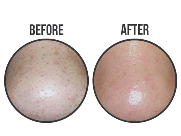 Mặt Nạ Lột Mụn Đầu Đen Ciracle Goodbye Blackhead Mask 5ml