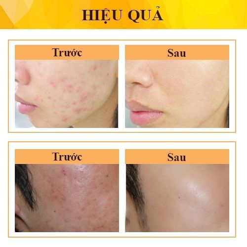 Gel Derma Forte Mờ Thâm Giảm Mụn 15g