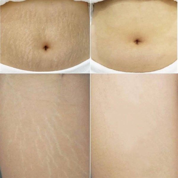 Kem Ngăn Ngừa & Giảm Rạn Da Cocoa Butter Formula Massage Cream For Stretch Marks Palmer's 125gr