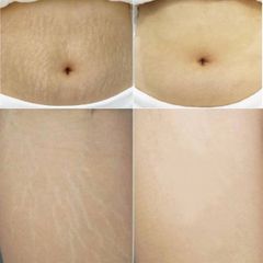 Kem Ngăn Ngừa & Giảm Rạn Da Cocoa Butter Formula Massage Cream For Stretch Marks Palmer's 125gr