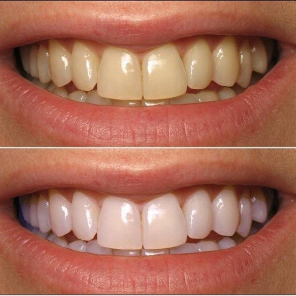 Bột Đánh Răng Tẩy Trắng Eucryl Toothpowder 50g