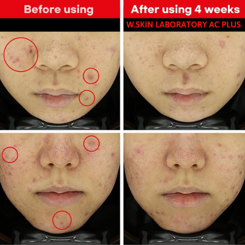 Kem dưỡng chuyên biệt dùng cho da dầu mụn AC+ CLEARING CREAM (60ml) {Có tem phụ nhập khẩu chính ngạch} giúp giảm mụn, mờ thâm mụn