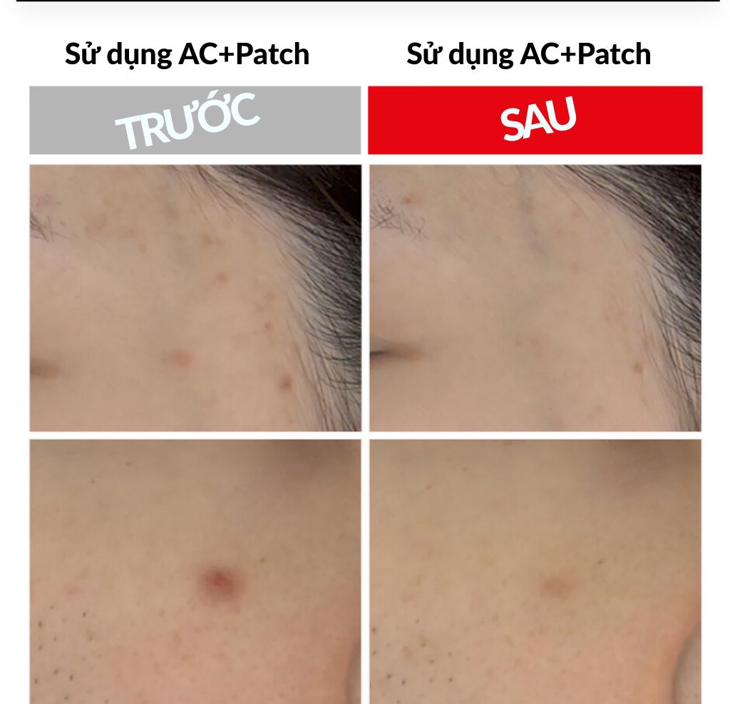 Miếng dán trị mụn giúp đẩy nhân mụn trứng cá, hạn chế thâm do mụn- AC+ TROUBLE PATCH (120 miếng) {Có tem phụ nhập khẩu chính ngạch}