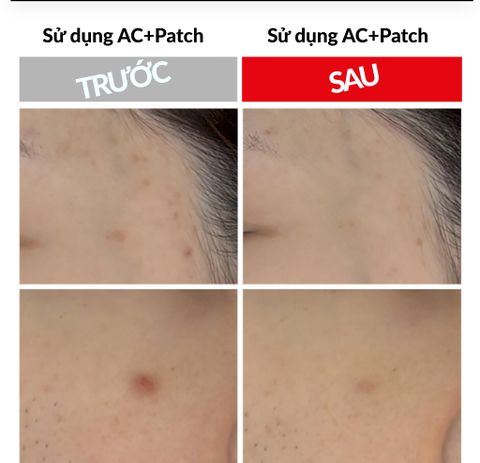 Miếng dán trị mụn giúp đẩy nhân mụn trứng cá, hạn chế thâm do mụn- AC+ TROUBLE PATCH (120 miếng) {Có tem phụ nhập khẩu chính ngạch}