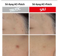 Miếng dán trị mụn giúp đẩy nhân mụn trứng cá, hạn chế thâm do mụn- AC+ TROUBLE PATCH (120 miếng) {Có tem phụ nhập khẩu chính ngạch}