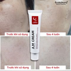 Kem trị nám hiệu quả sau 4 tuần - A.M (Anti-Melasma) CREAM (50ml)