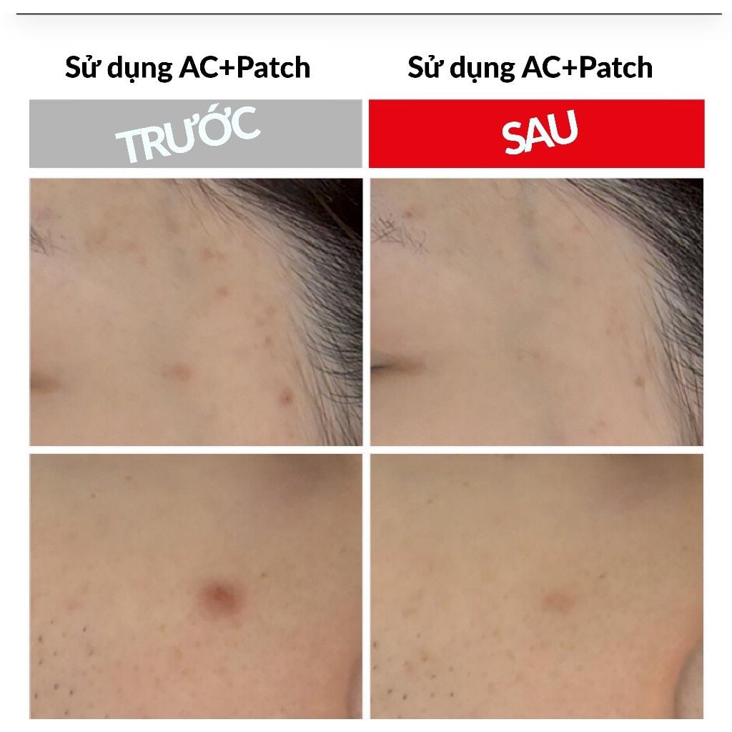 Vỉ lẻ Miếng dán mụn trứng cá - AC+ TROUBLE PATCH (12 miếng)