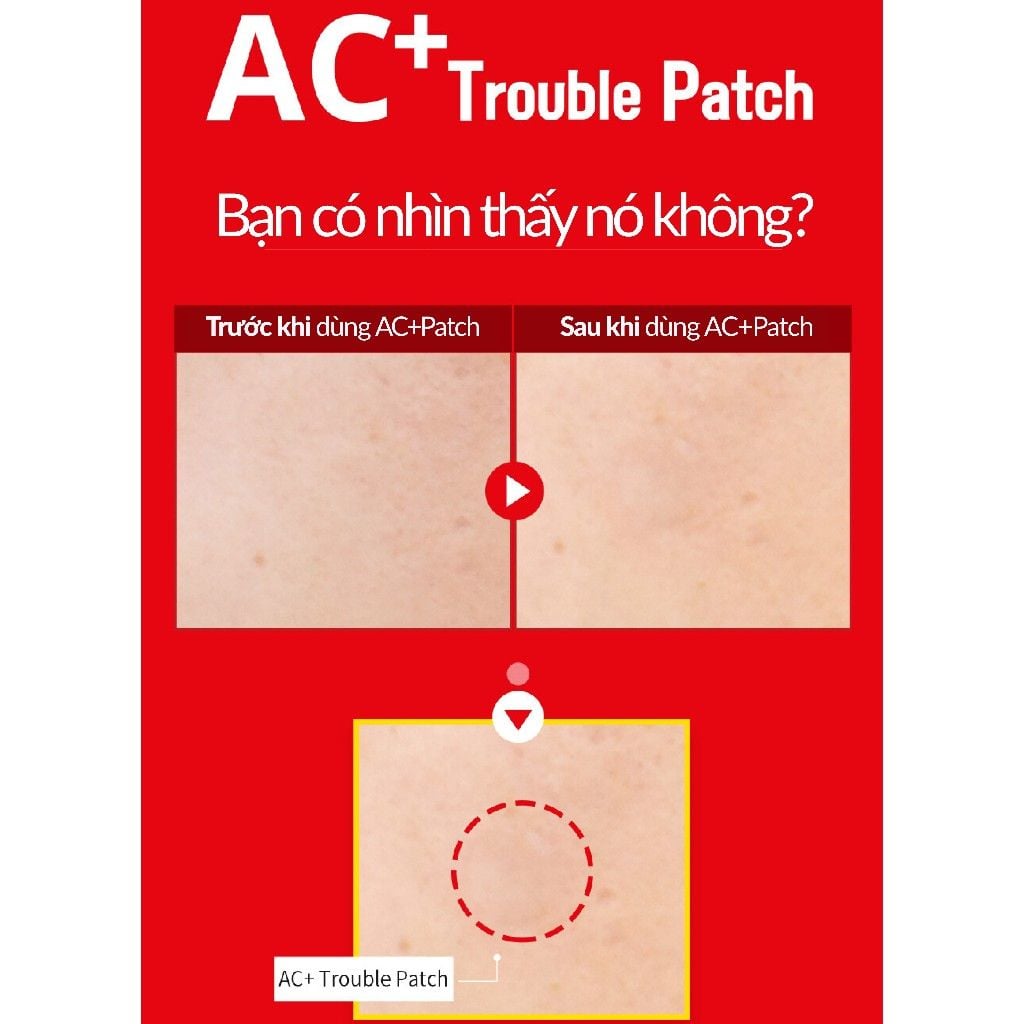 Vỉ lẻ Miếng dán mụn trứng cá - AC+ TROUBLE PATCH (12 miếng)