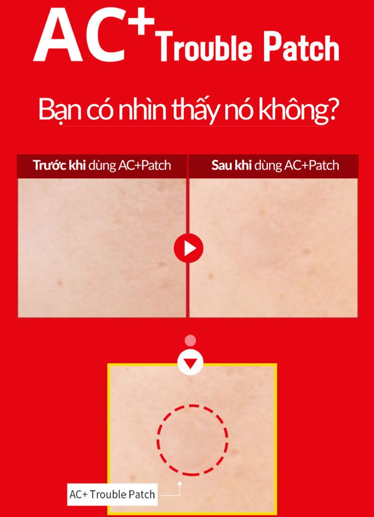 Miếng dán trị mụn giúp đẩy nhân mụn trứng cá, hạn chế thâm do mụn- AC+ TROUBLE PATCH (120 miếng) {Có tem phụ nhập khẩu chính ngạch}