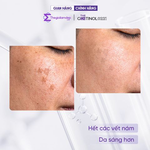 Kem MELA OFF CREAM (mela-off cream) phân hủy sắc tố, xử lý nám da The Gentinol 0221 50gr