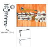  Microimplant - Minivis dùng trong chỉnh nha - Túi 1 cái 