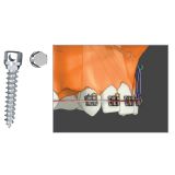  Microimplant - Minivis dùng trong chỉnh nha - Túi 1 cái 