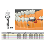  Microimplant - Minivis dùng trong chỉnh nha - Túi 1 cái 