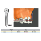  Microimplant - Minivis dùng trong chỉnh nha - Túi 1 cái 