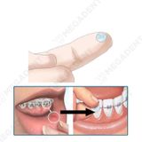  Orthodontic Wax - Sáp nha khoa giảm đau khi niềng răng - Hộp 2 vỉ 