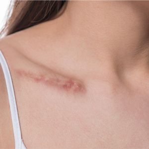 Kem trị sẹo Bepanthen 20g