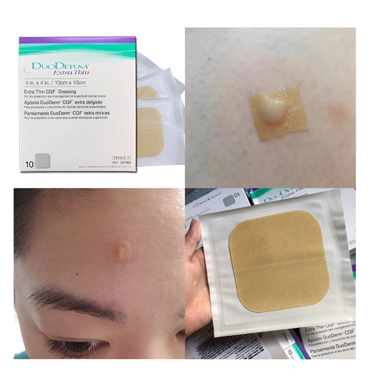  Băng dán Duoderm Extra Thin, chất lượng cao, sản xuất tại Mỹ 